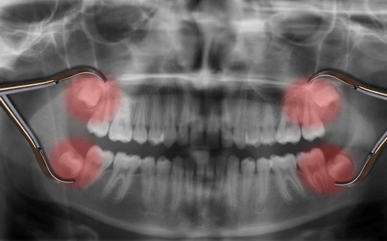 display four wisdom teeth over x-ray
