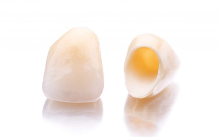 Close-up of two prosthetic teeth